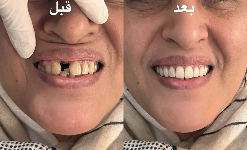 عکس قبل و بعد لمینیت دندان